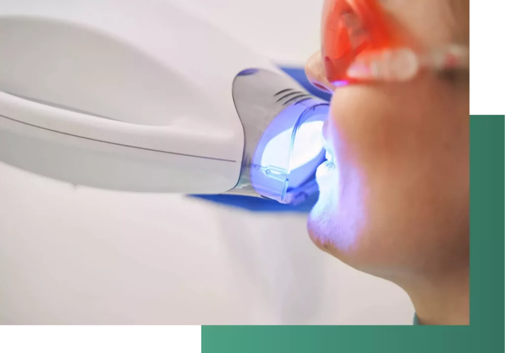 Zahnaufhellung mit LED-Licht